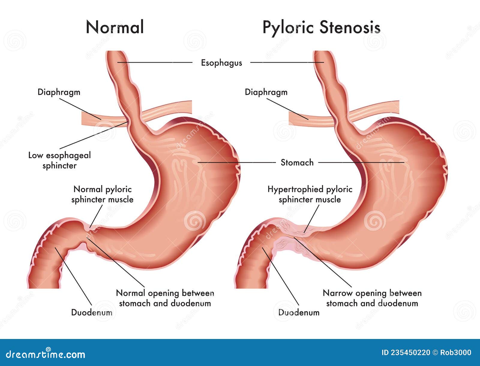 pyloric stenosis medical 