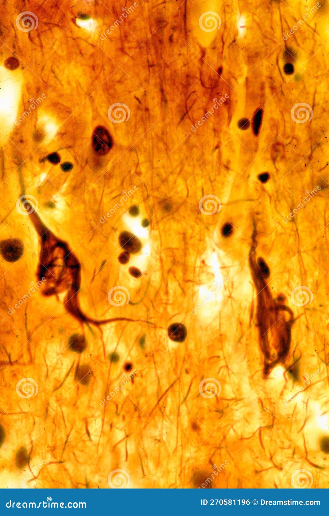 pyramidal neuron. neurofibrillary tangles