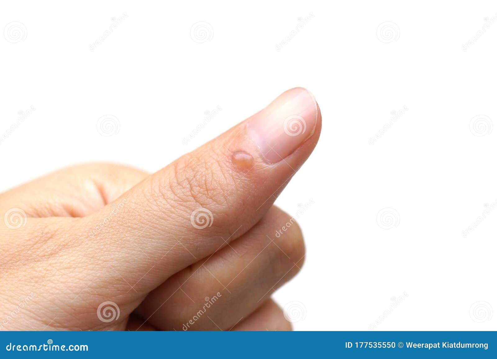 Queimadura no dedo foto de stock. Imagem de isolado - 177535550