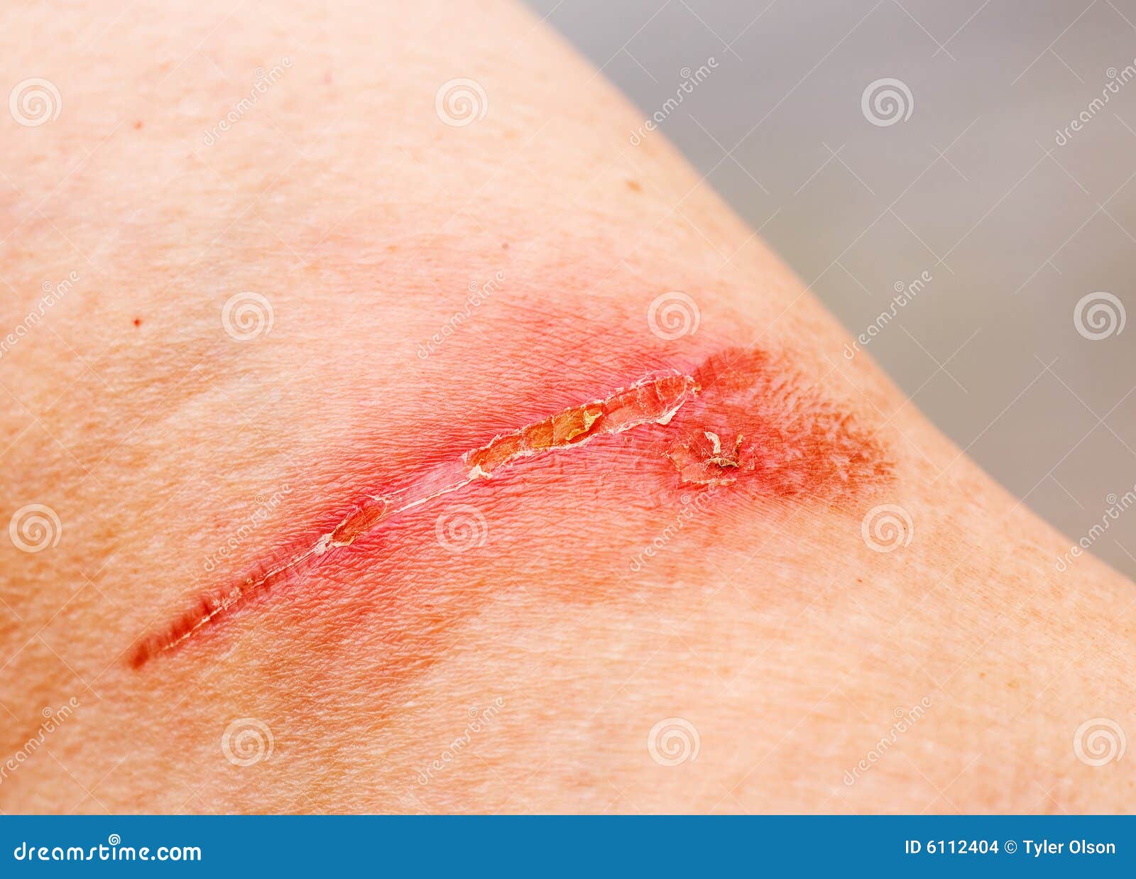 Cicatriz de quemadura foto de archivo. Imagen de quemadura - 6112404, image size:1600x1238