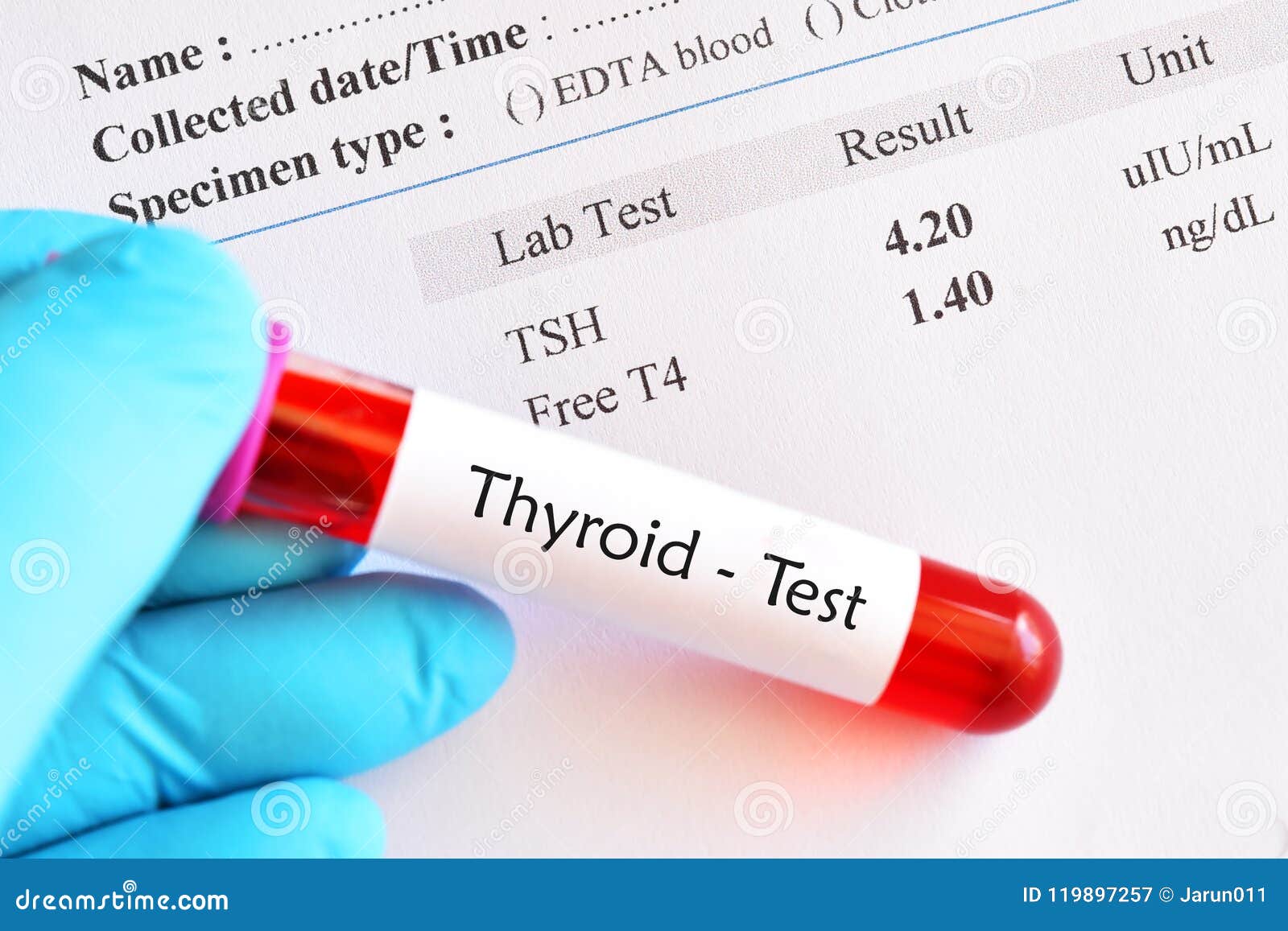 resultat d essai normal d hormone thyroidienne image stock image du patient thyroide 119897257