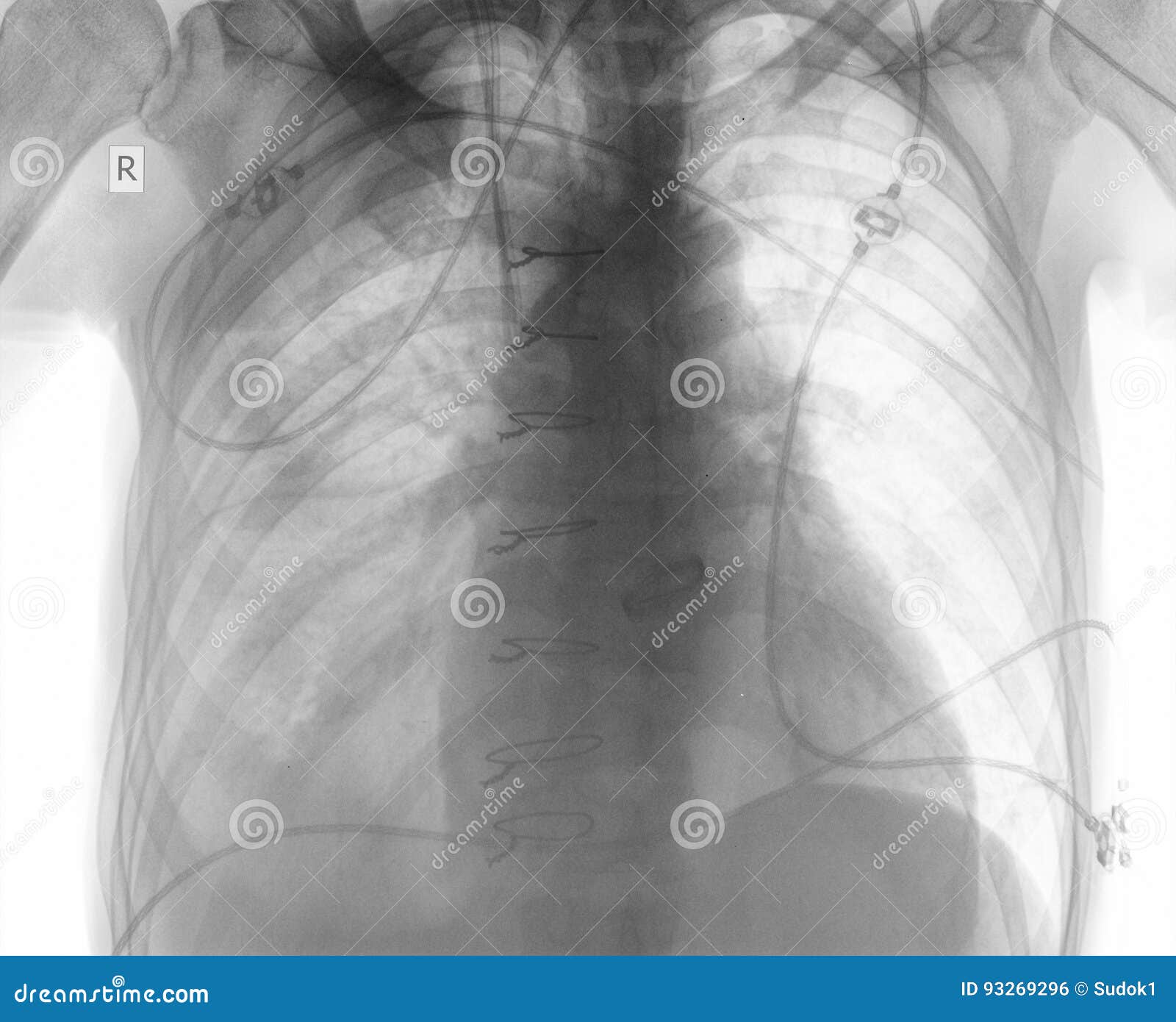 R-control of Patient after Cardiac Surgery Stock Photo - Image of chest ...