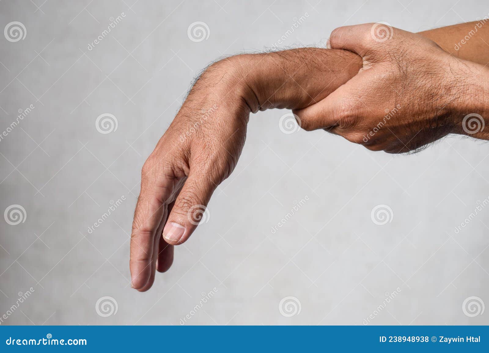 Radial Nerve Injury or Wrist Drop Stock Photo Image of aging