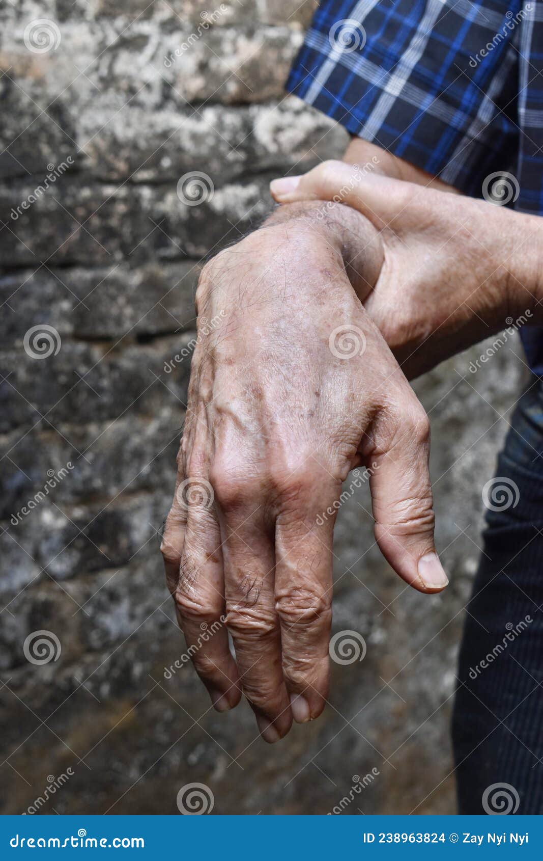 Radial Nerve Injury or Wrist Drop Stock Photo Image of nerve, aging