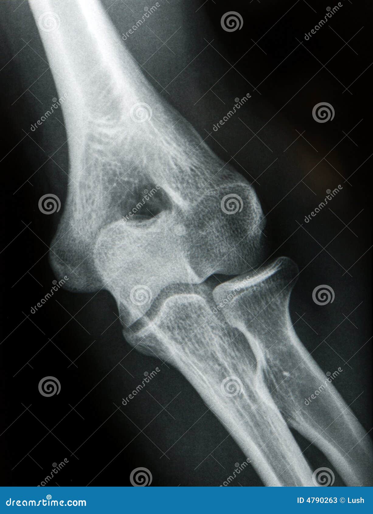 Radiografia do cotovelo imagem de stock. Imagem de cuidado - 4790263, image size:1227x1690