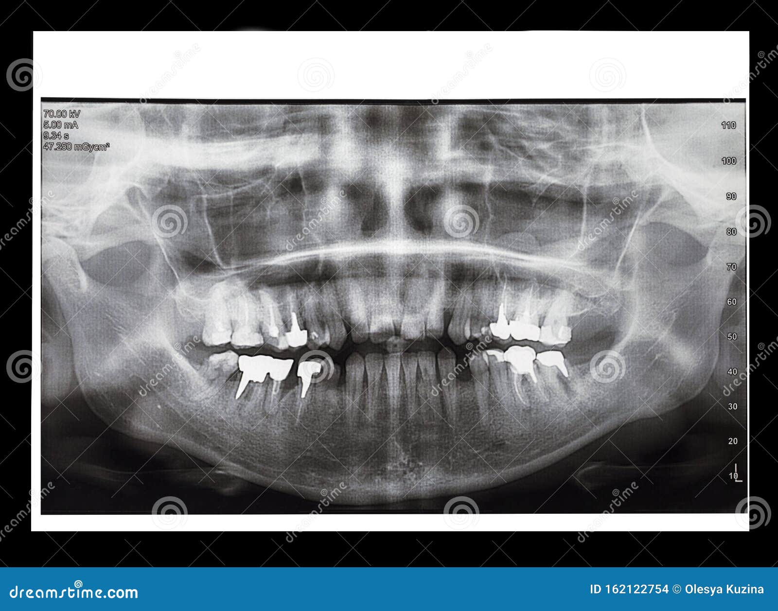 BK mostra radiografia de consumidores que deslocaram a mandíbula