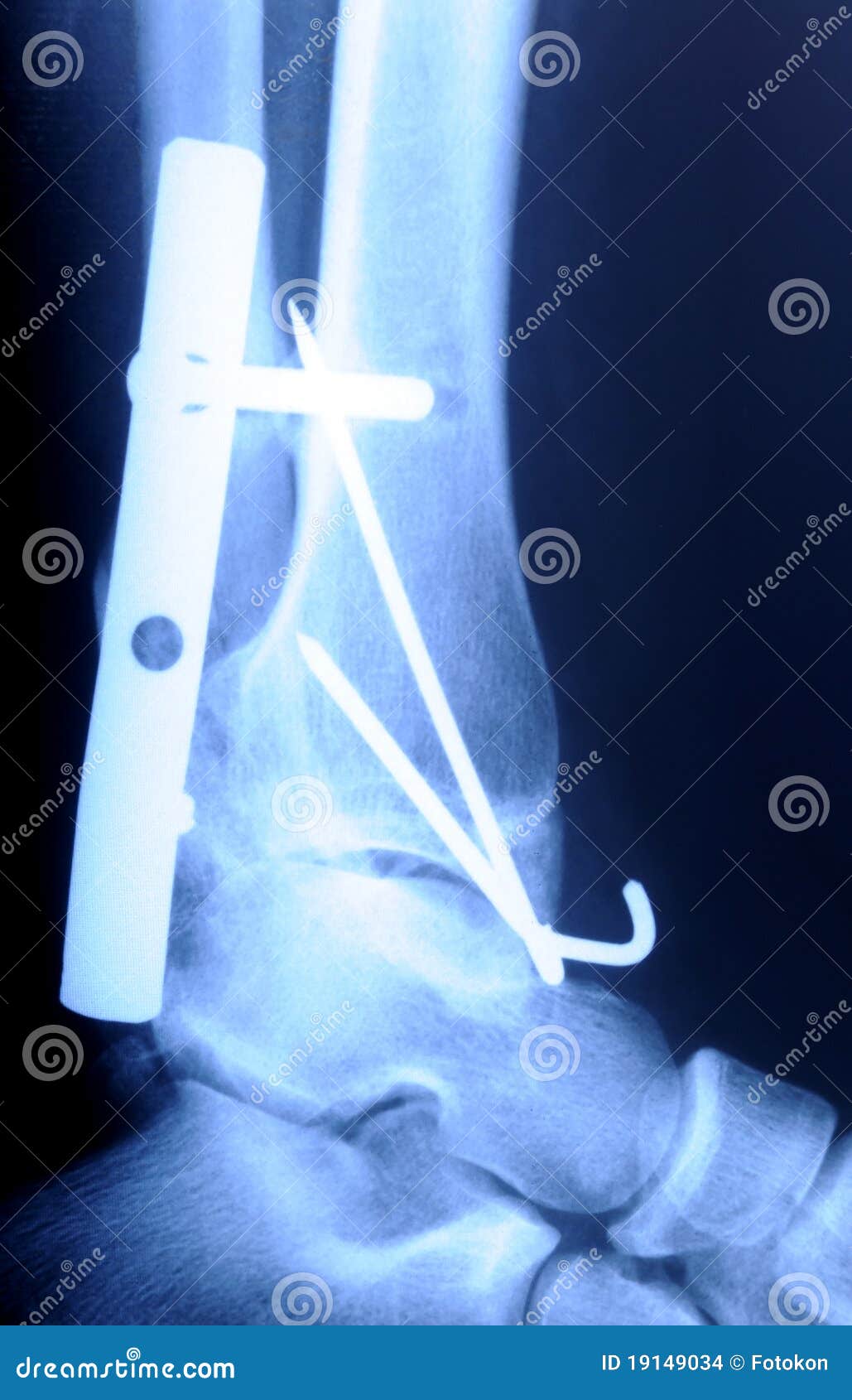 Fracture Of The Ankle Bones In A Teenage Girl Patient With A Cast And