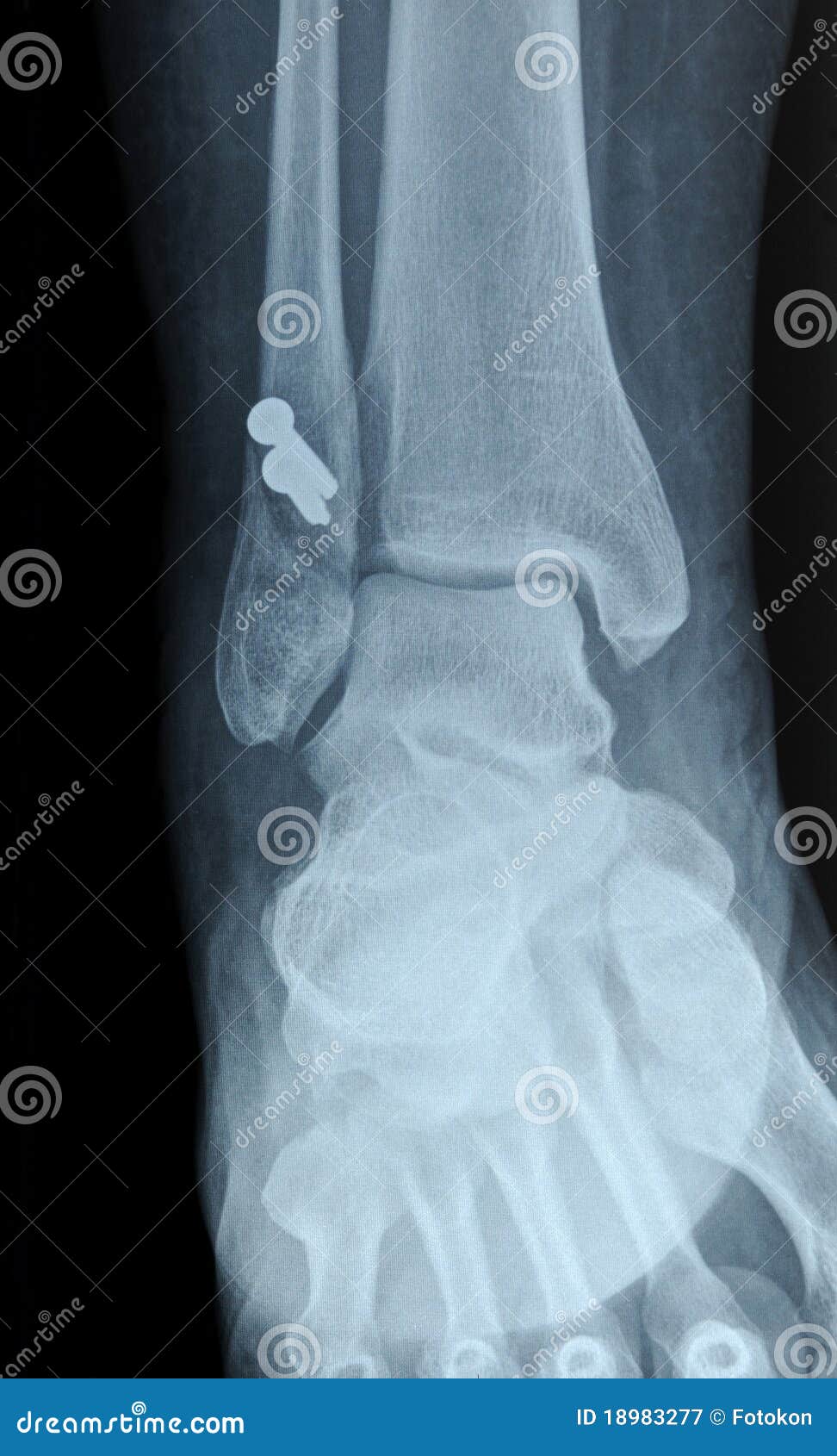 fracture fibula fracture fibula