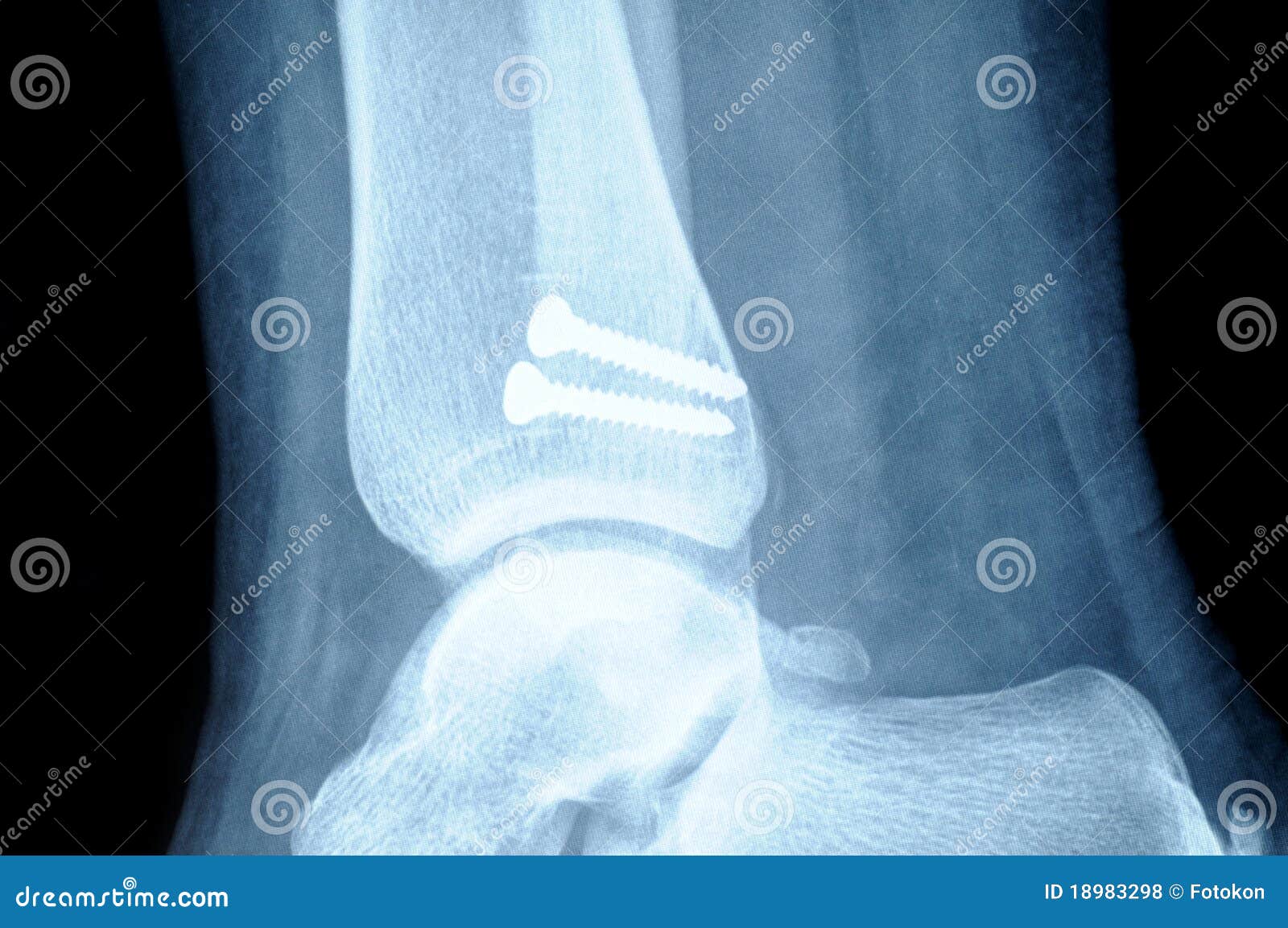 fracture fibula