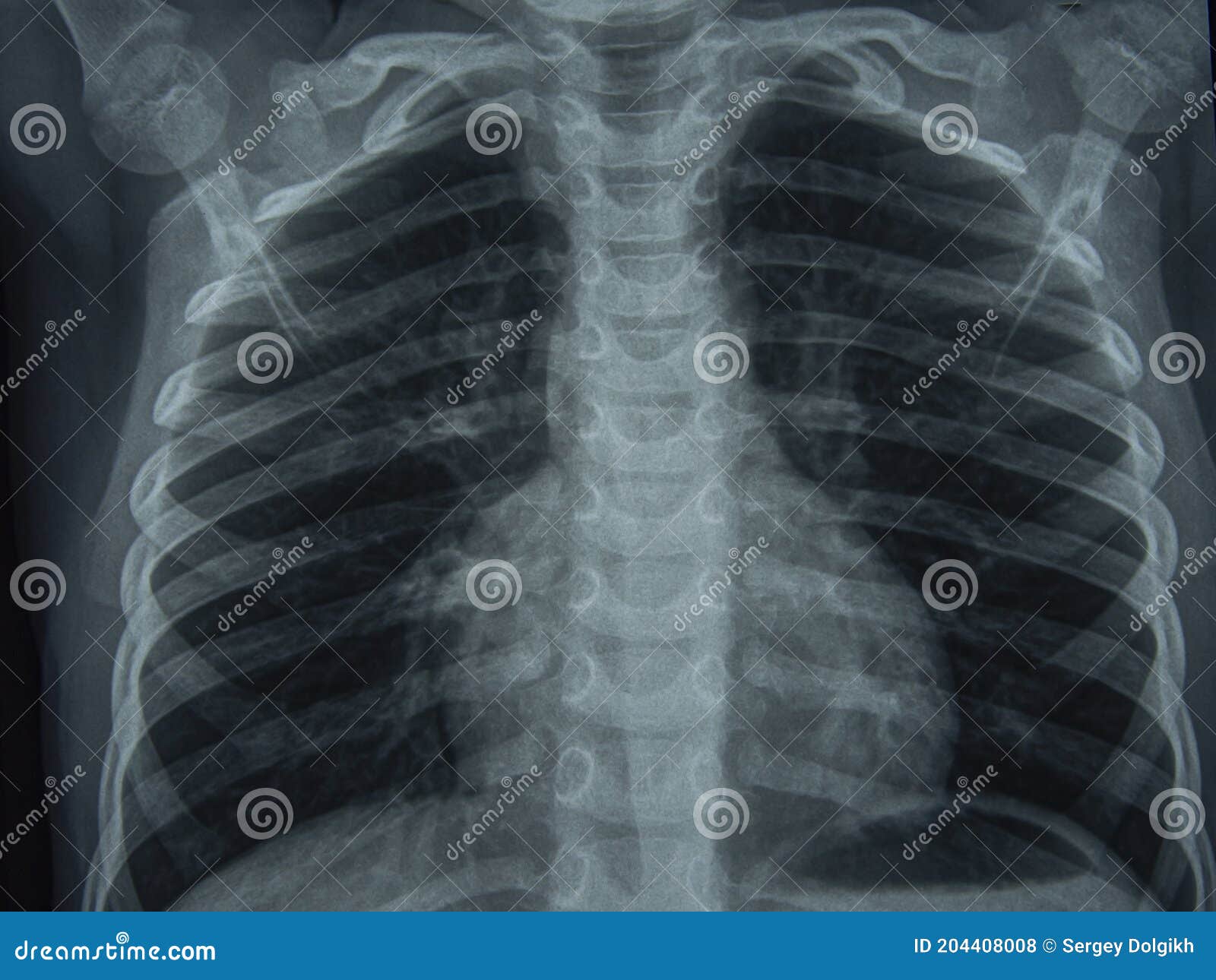 radiographic image or x-ray image of human chest for a medical diagnosis . check up concept