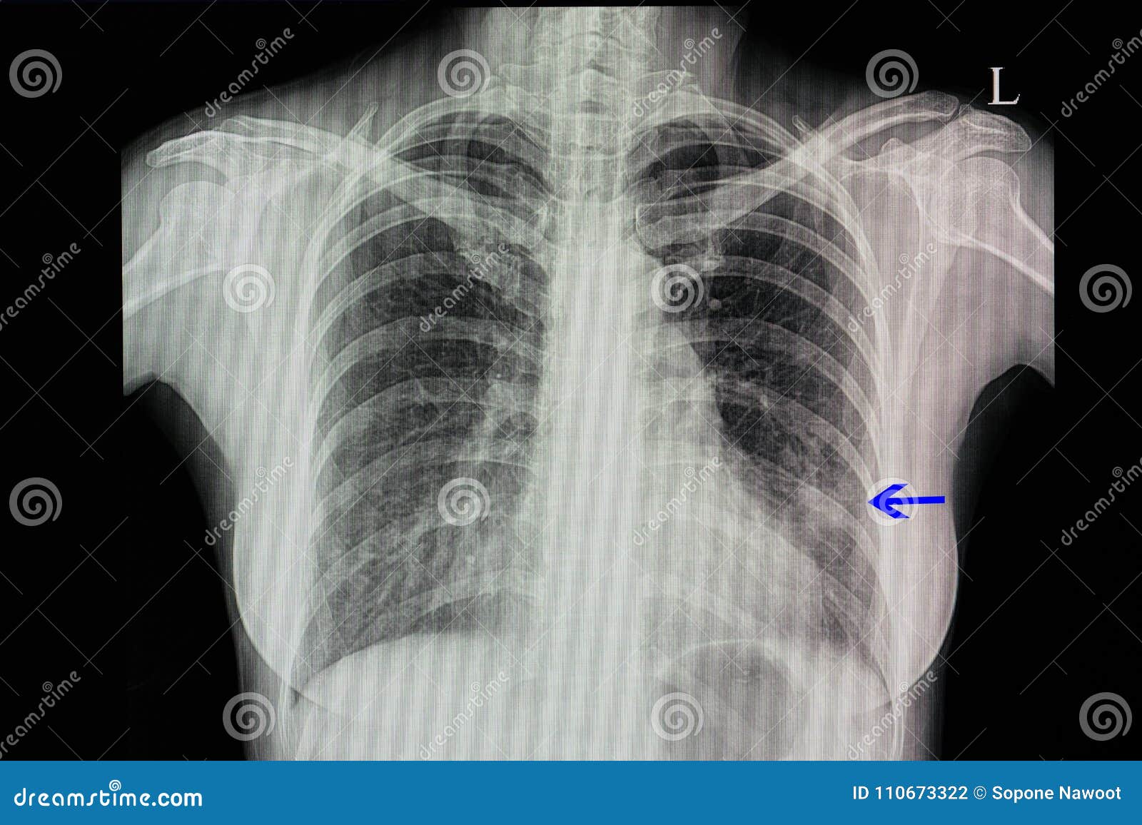 Radiographie De La Poitrine D Un Patient Presentant La Pneumonie Photo Stock Image Du Gauche Blanc