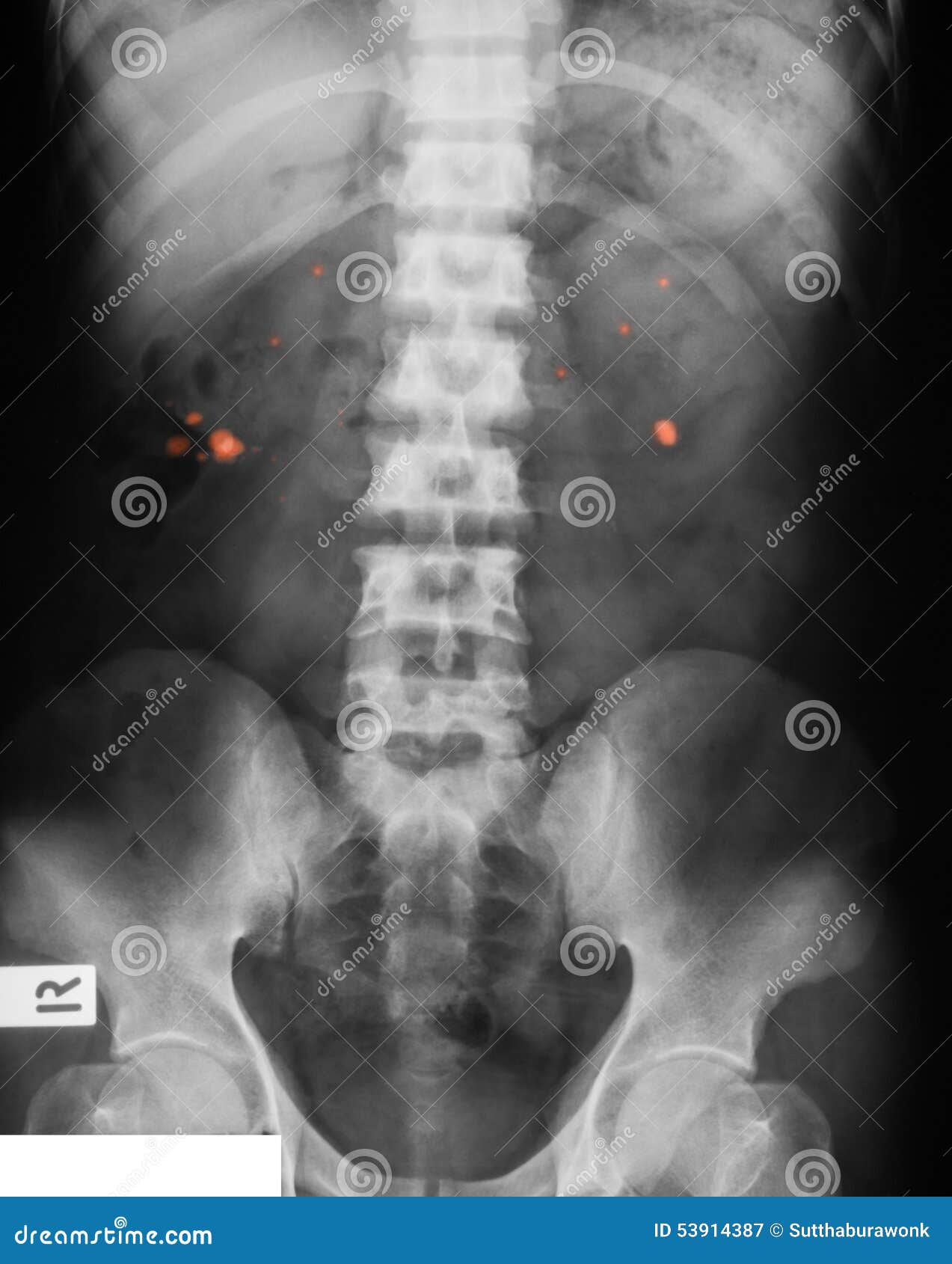 radiographiez-l-image-de-kub-simple-vue-en-supination-image-stock