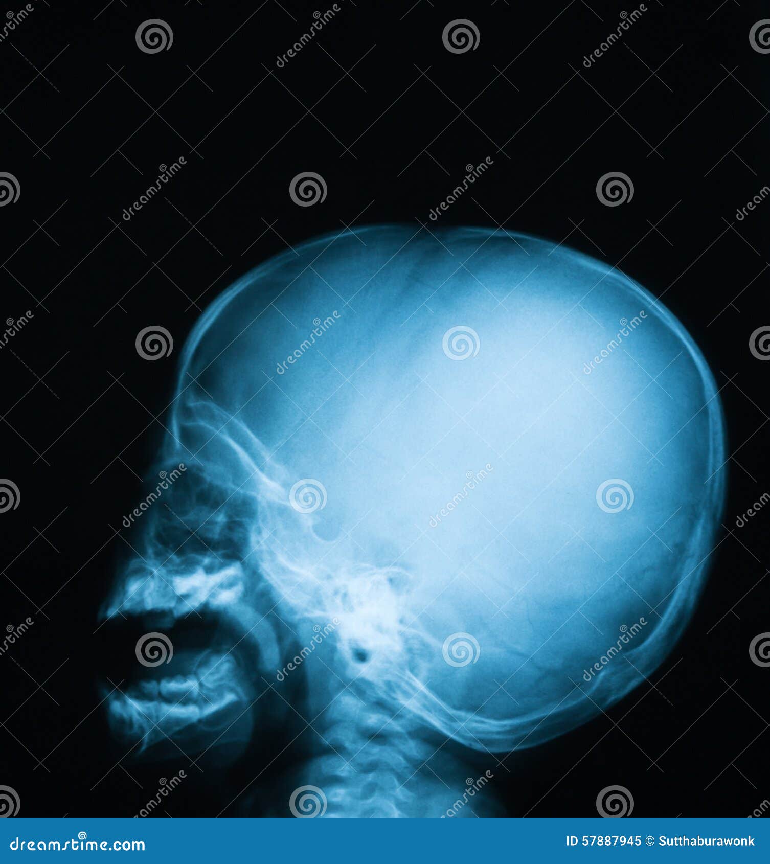 Radiographiez L Image Du Crane De Bebe Vue De Face Image Stock Image Du Vieux Parietal