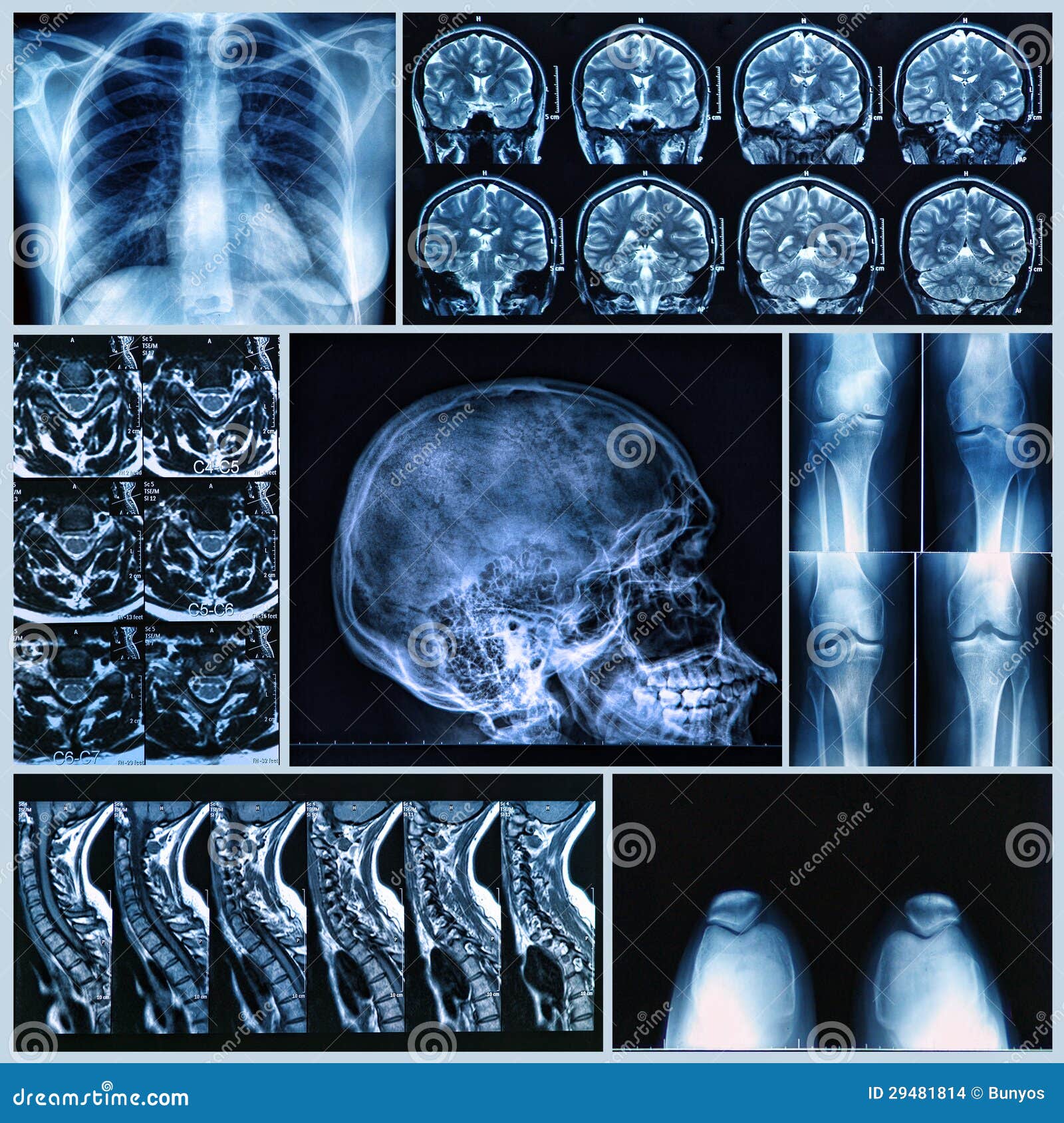 radiography of human bones
