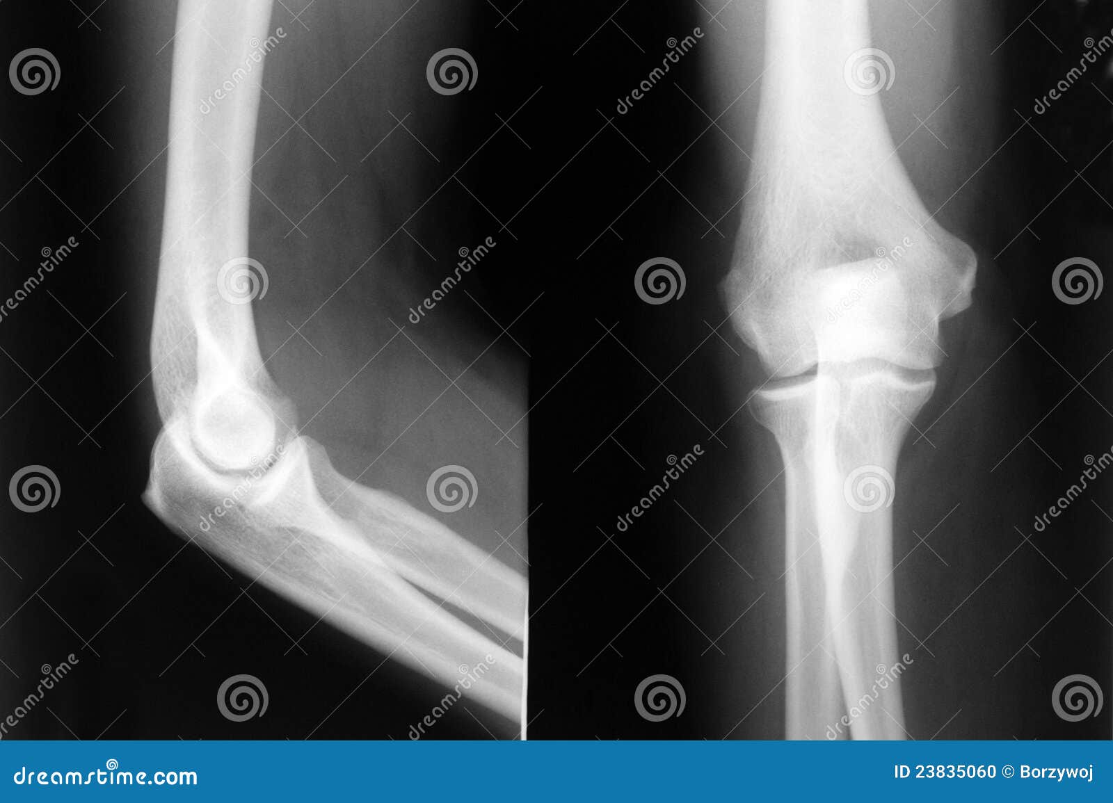 Raio-X do cotovelo foto de stock. Imagem de raio, varredura - 23835060, image size:1600x1155