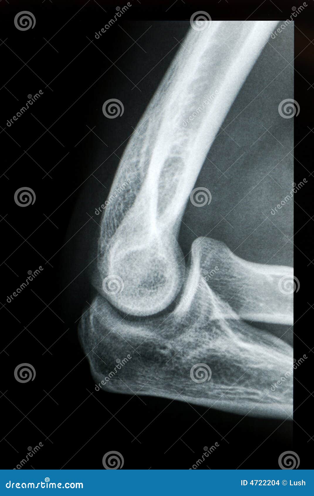 Radiografia do cotovelo foto de stock. Imagem de estrutura - 4722204, image size:1071x1690