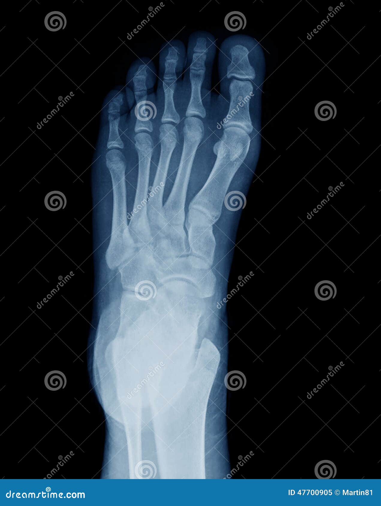 Raio X Do Pe Imagem De Stock Imagem De Raio 47700905