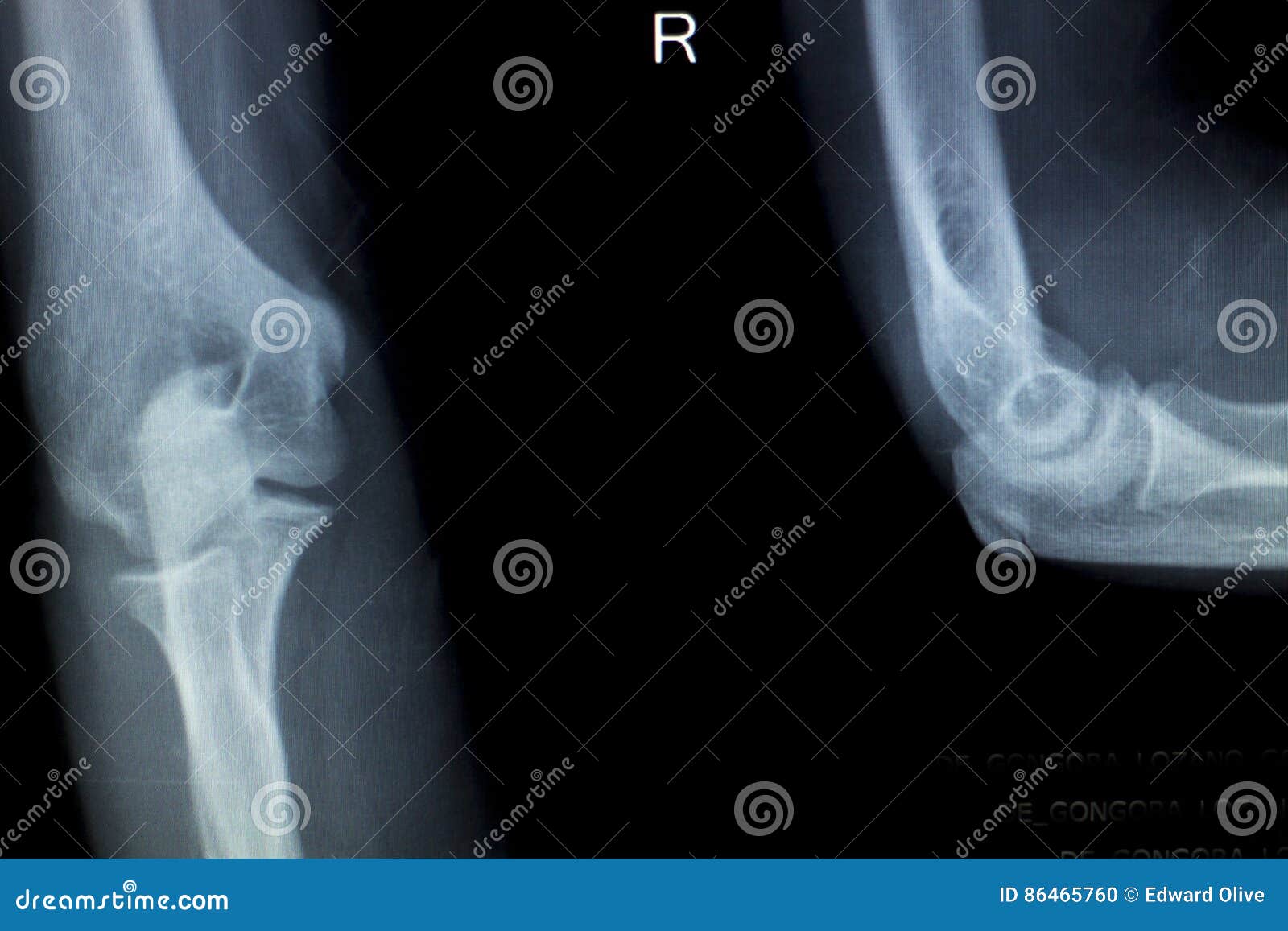 Radiografia De Lesão Da Articulação Do Cotovelo Foto de Stock - Imagem de  raio, humano: 86465760, image size:1600x1157