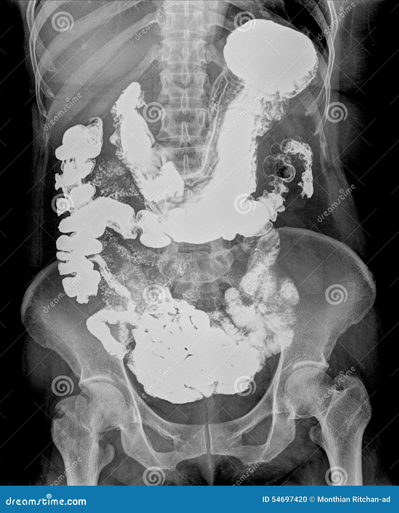 O raio X do humen incha-se com lotes do gás, obstrução