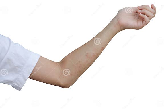 Red Rash On The Arms Stock Image Image Of Infestation 106704087