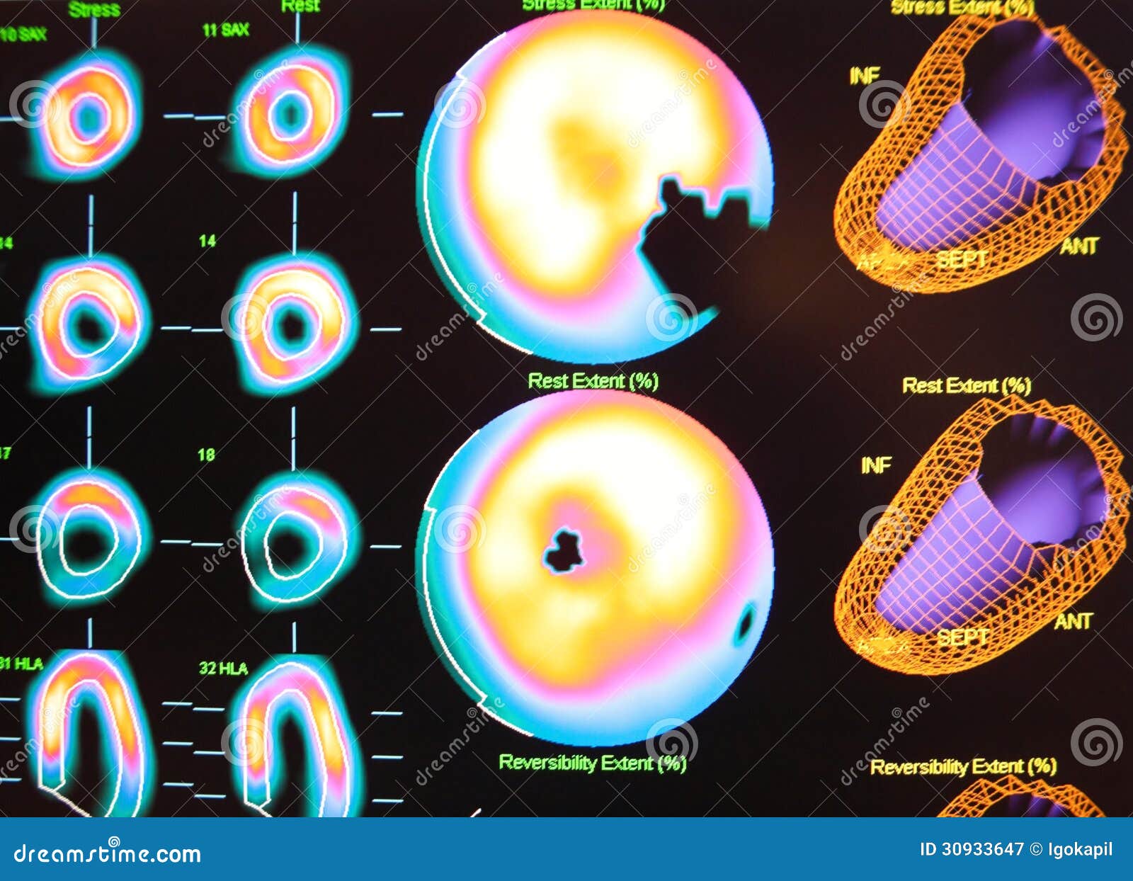 myocardial ischemia nuclear medicine