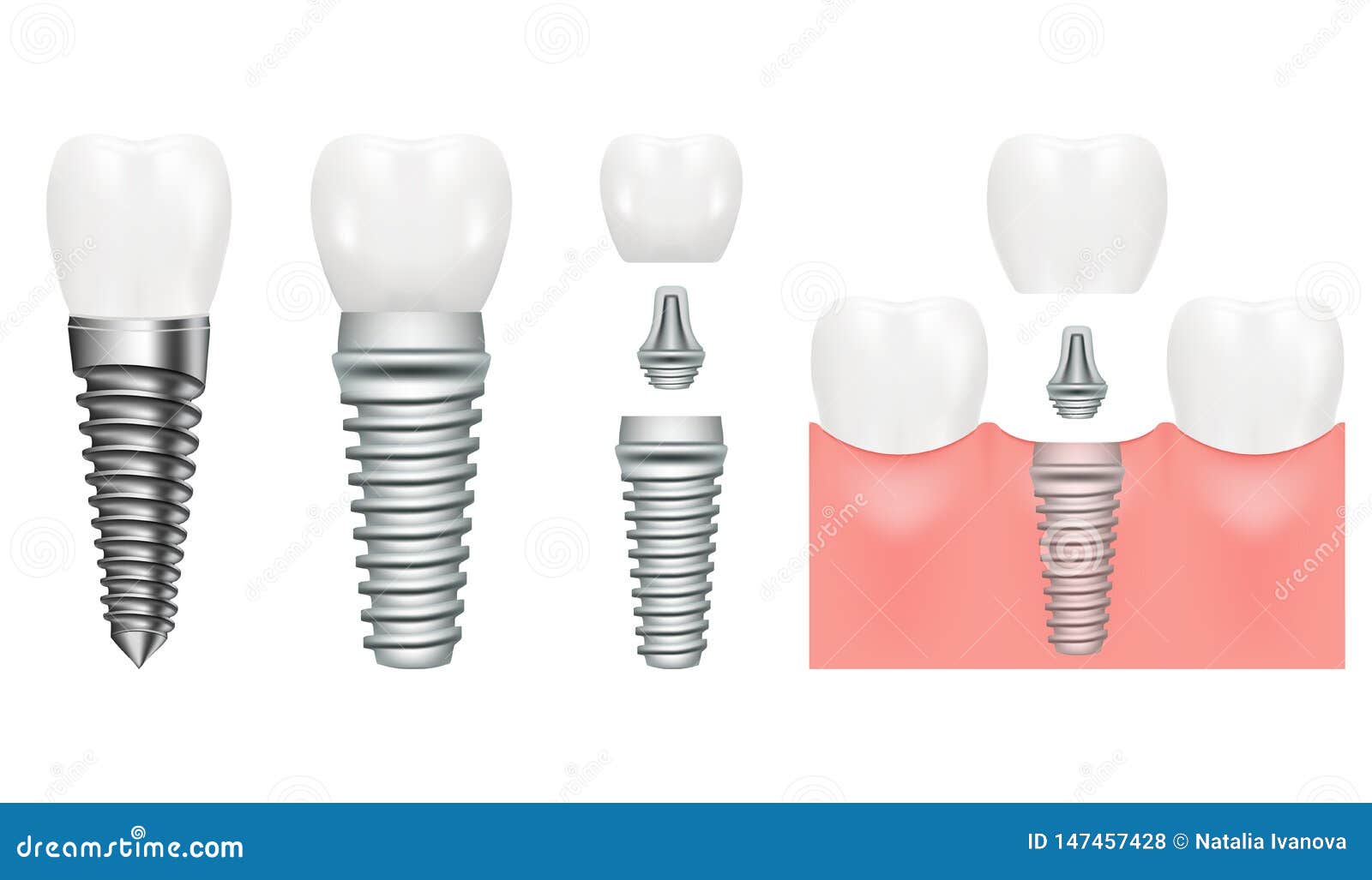 realistic dental implant structure with all parts crown, abutment, screw. dentistry. implantation of human teeth. 