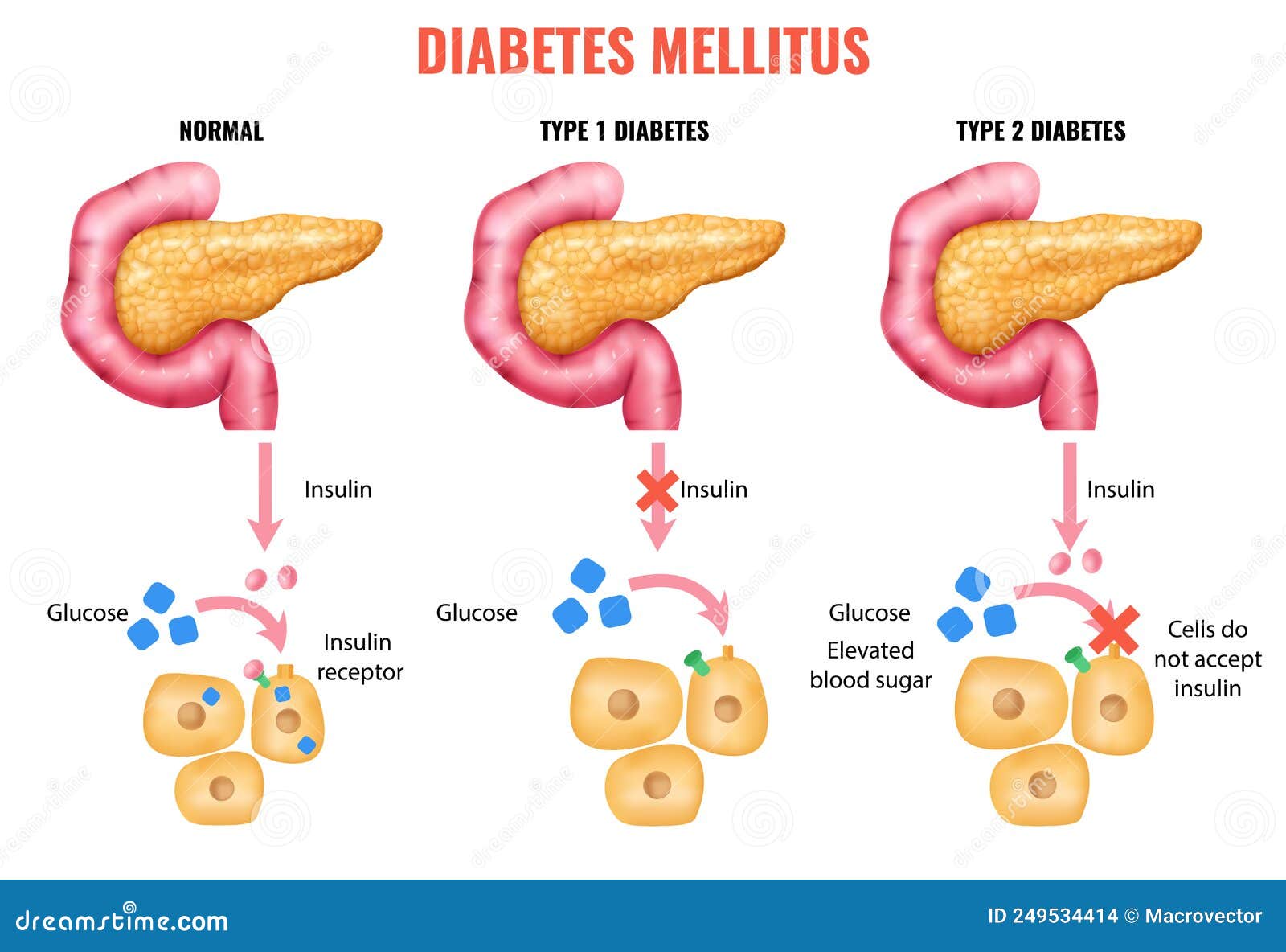 Realistic Diabetes Mellitus Infographics Vector Illustration