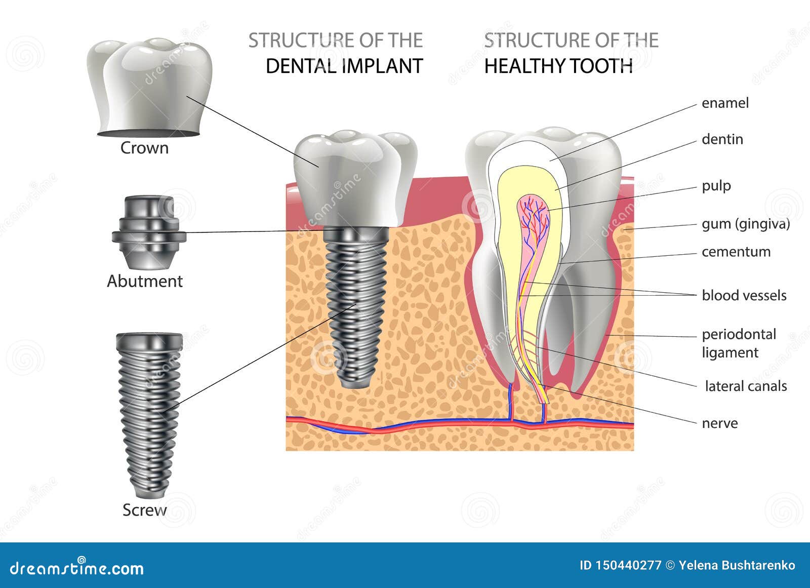 realistic healthy tooth and structure, dental implant with all parts: crown, abutment, screw.