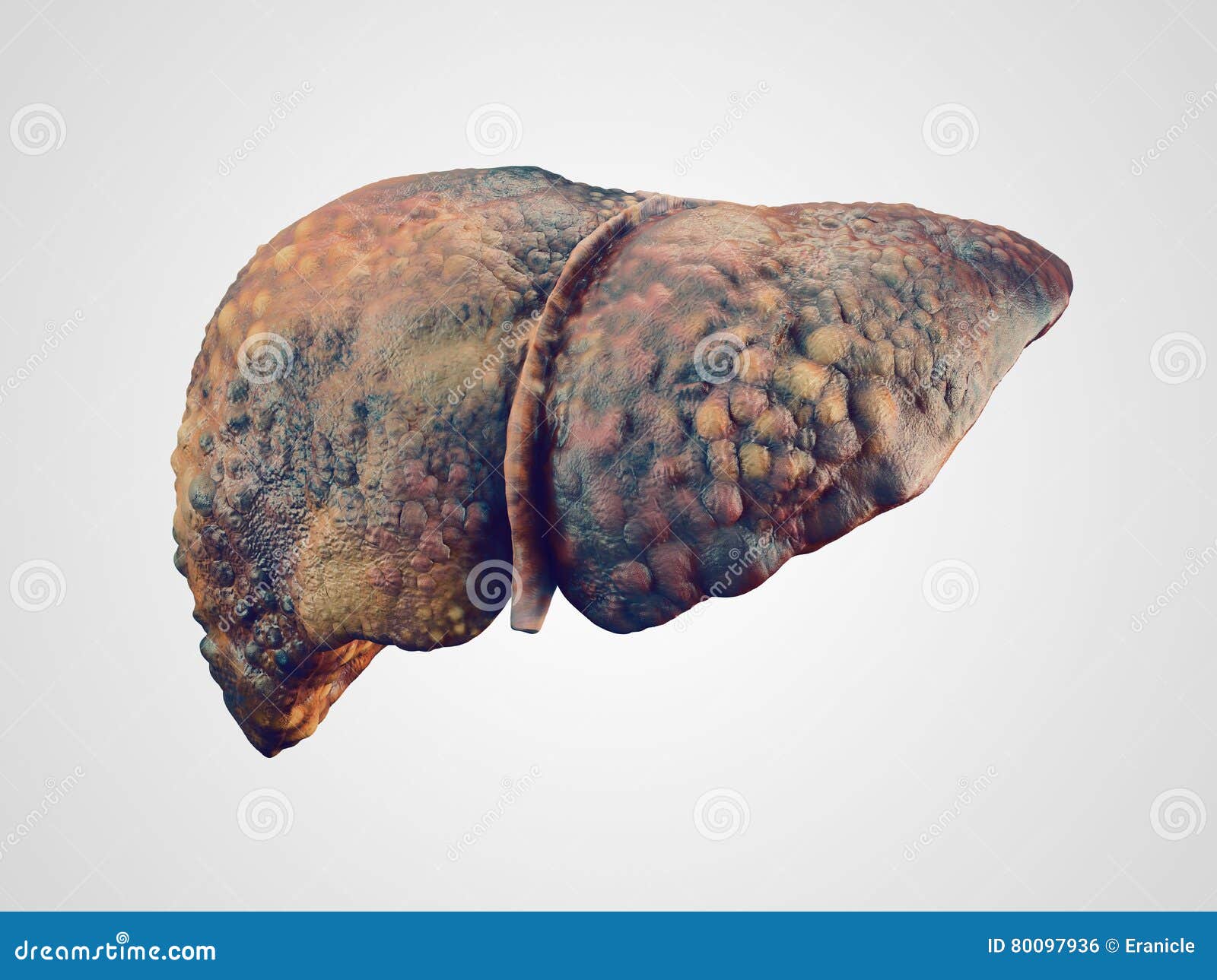 realistic  of cirrhosis of human liver