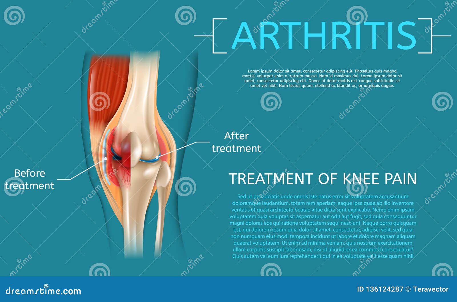 prostatitis aids- vel