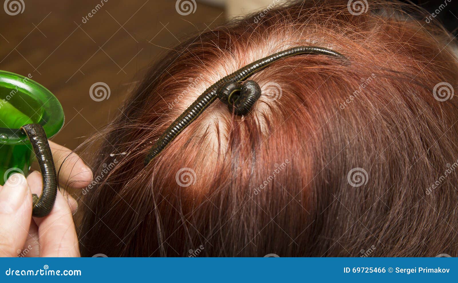 Reatment of People of Medical Leeches. Stock Photo - Image of collagenase,  bleeding: 69725466
