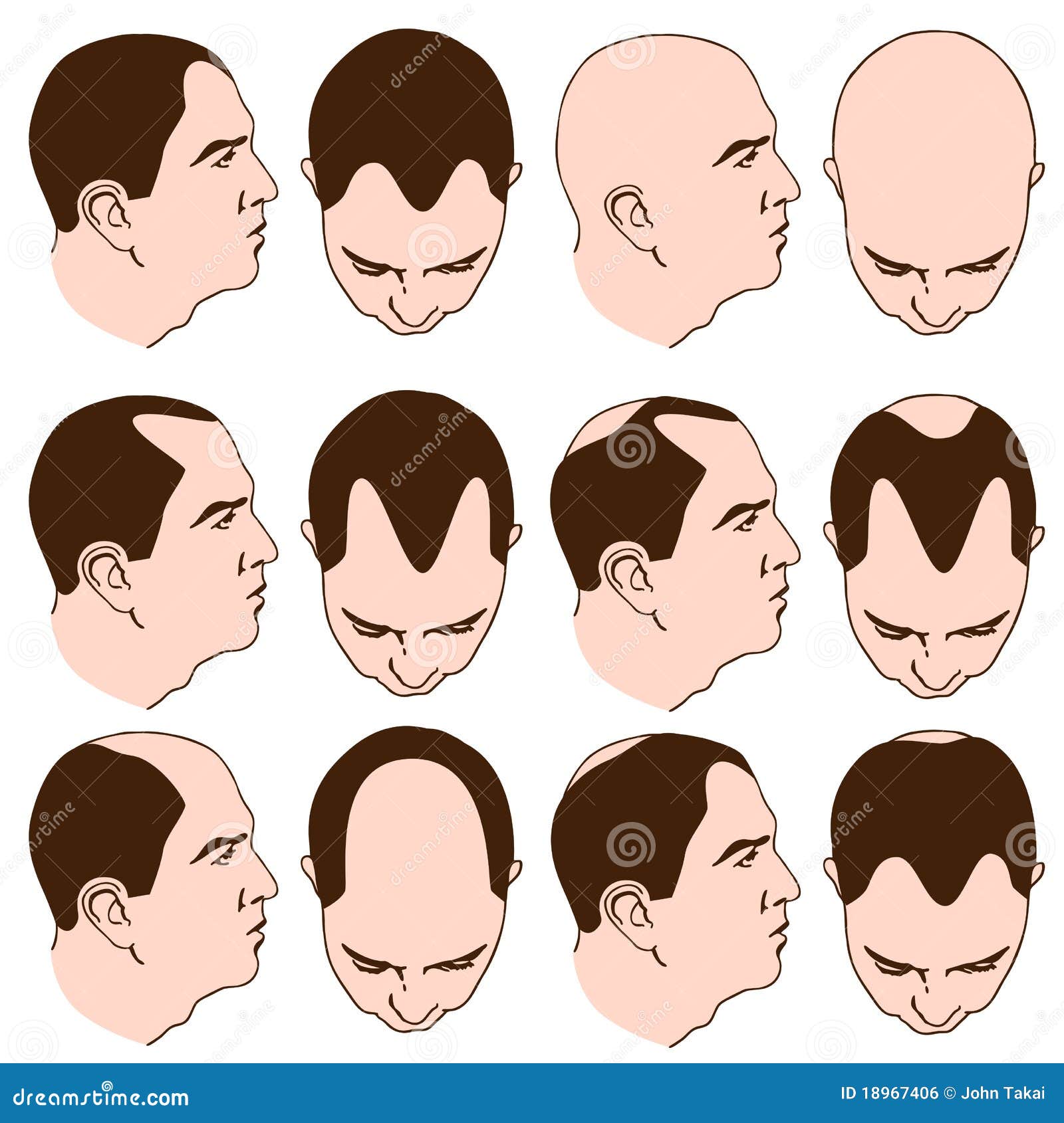 Receding Hairlines stock vector. Illustration of hair 18967406