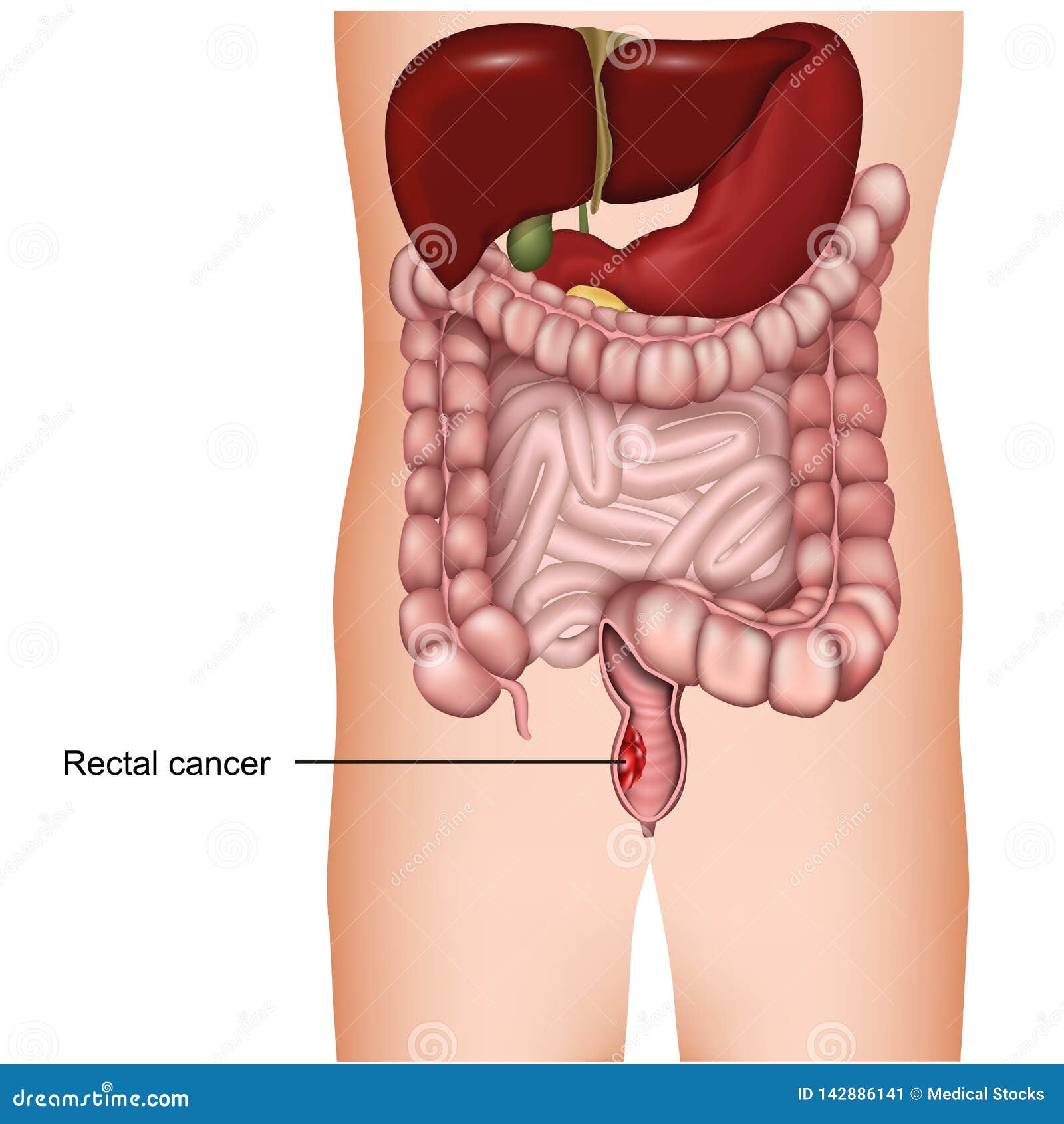 cancer rectal image