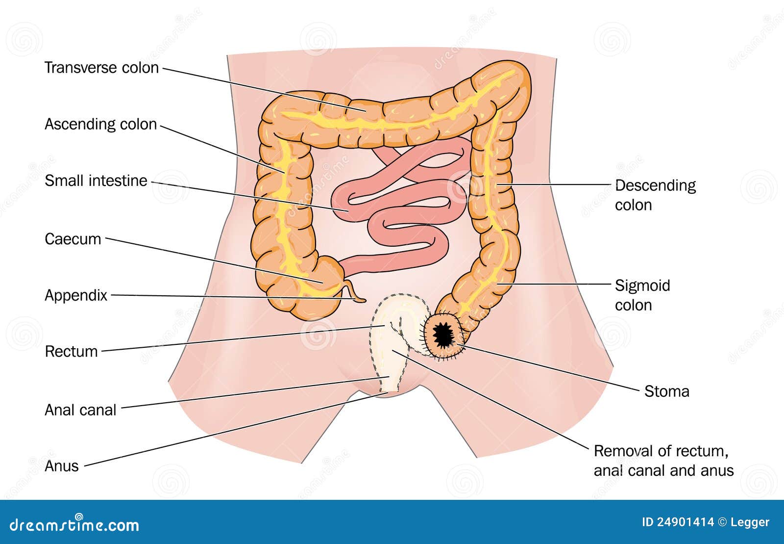 rectal cancer and stoma