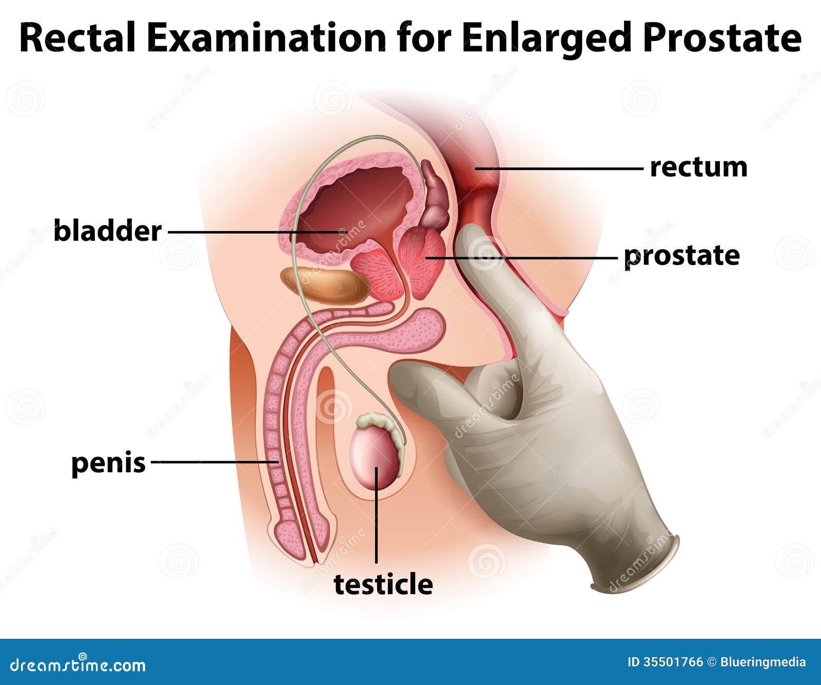 prostatitis rectum)