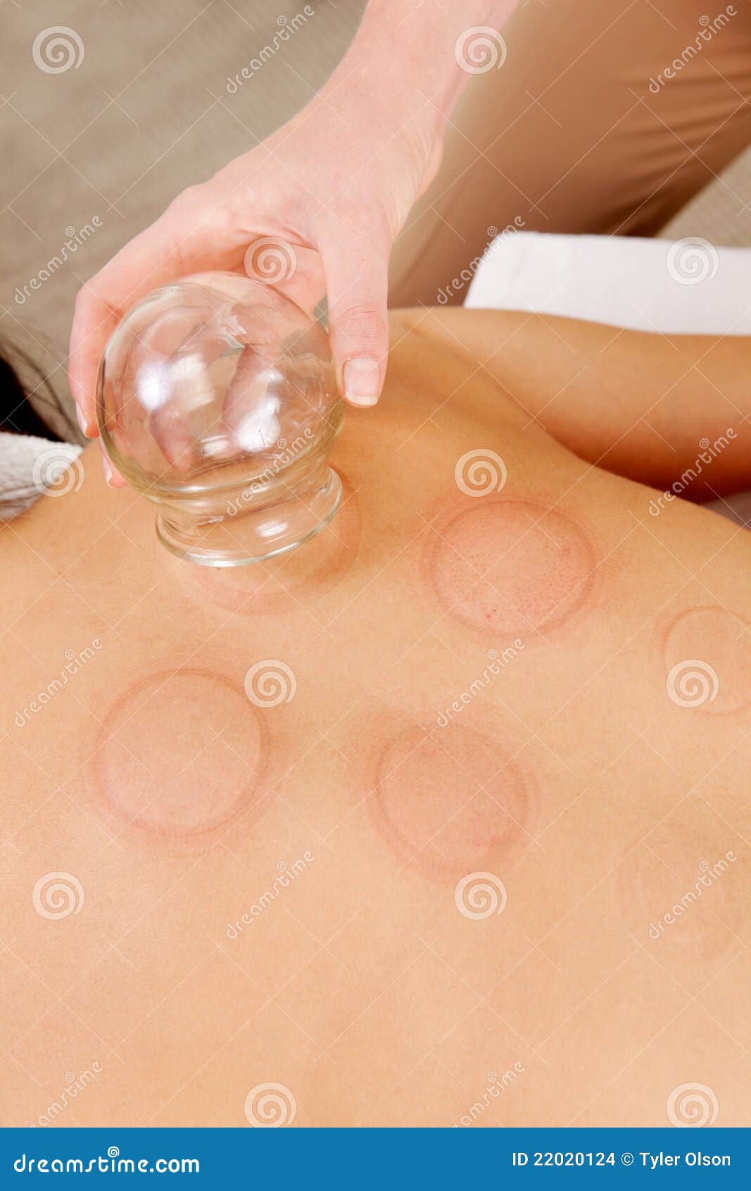 Red Fire Cupping Marks Stock Images Image 22020124