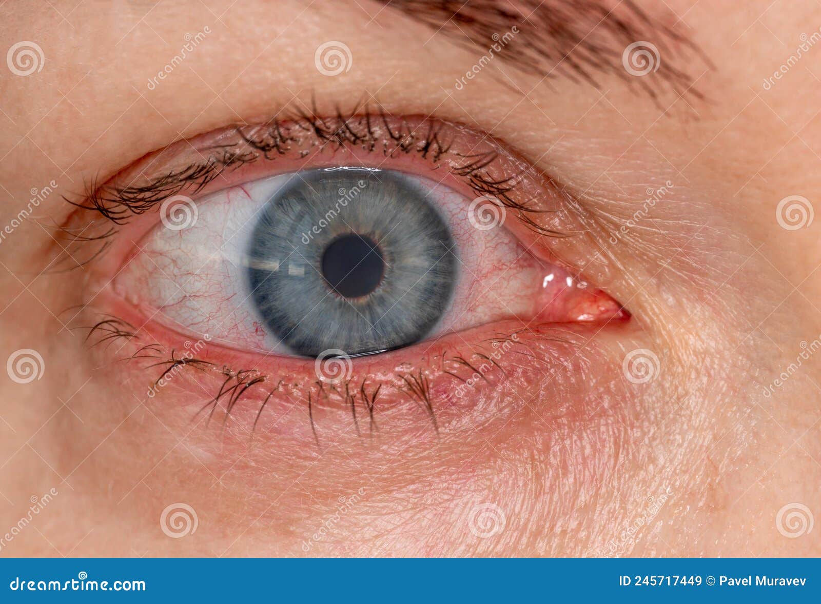 Red Inflamed Eye with Contact Lens, Close-up Macrophoto. Dilation of Blood  Vessels of Eye, Strain from Computer. Treating Dry and Stock Image - Image  of blood, medical: 245717449