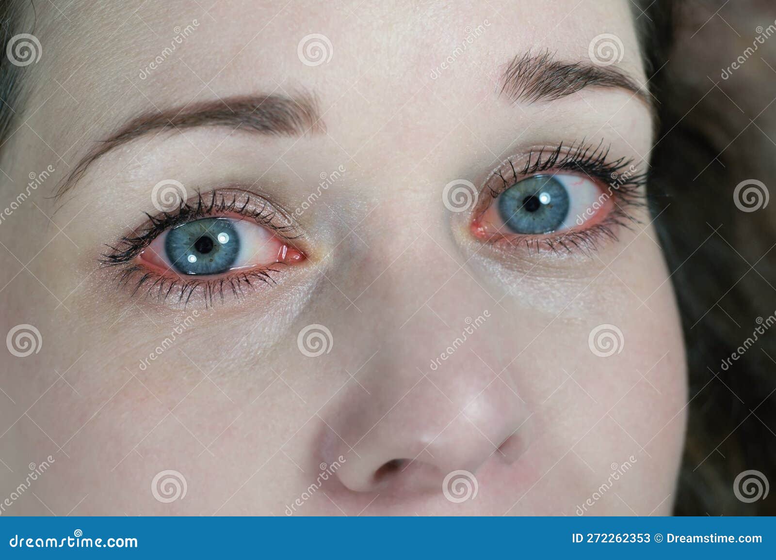 Red Irritated Human Eye Close Up, Allergy Symptom Stock Image Image