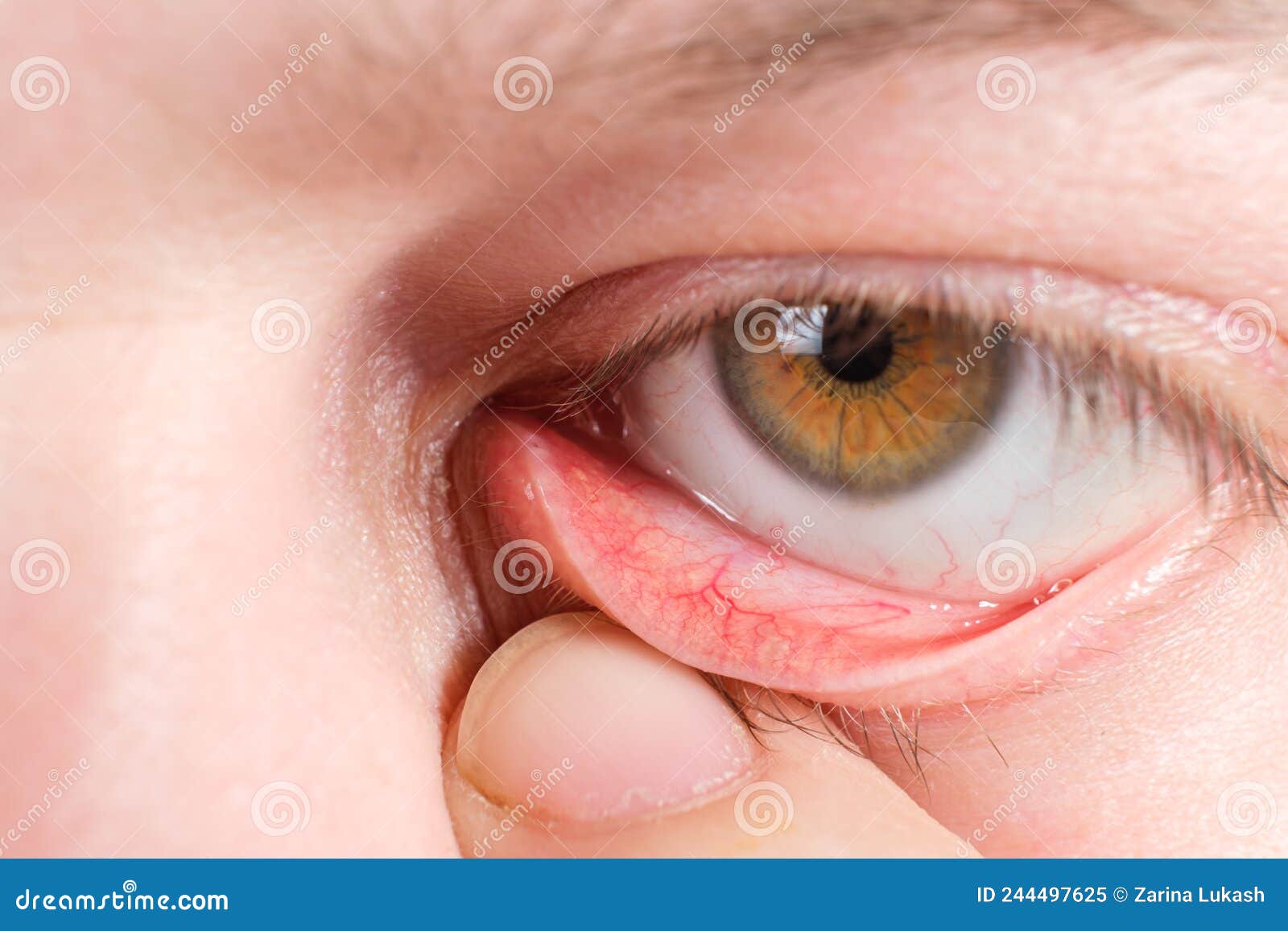 Inflammated eye Conjunctivitis or pink eye Stock Vector Image & Art