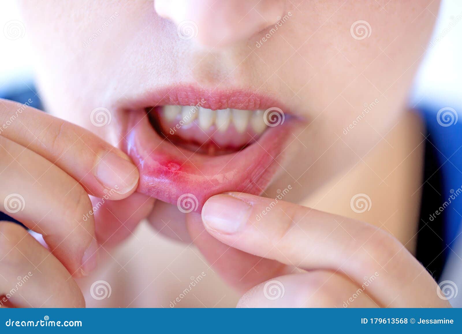 red and painful canker sore