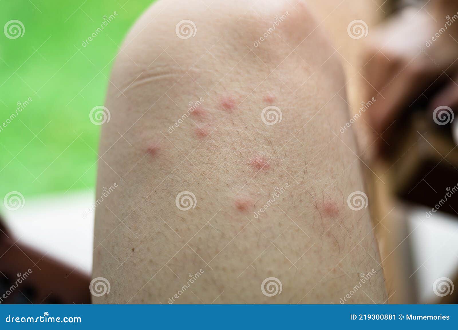 Swollen Blisters On The Skin Caused By Mosquito Bites At Thigh Stock Photo  - Download Image Now - iStock