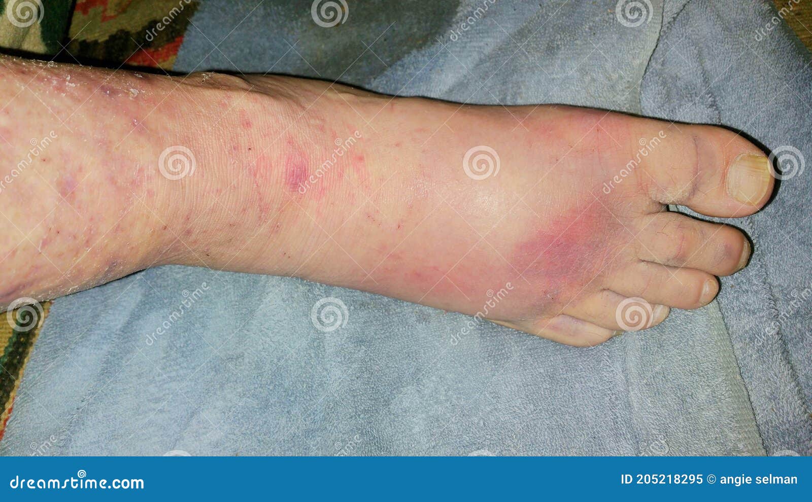 Red Swollen and Bruised Foot Stock Image Image of swollen, limb