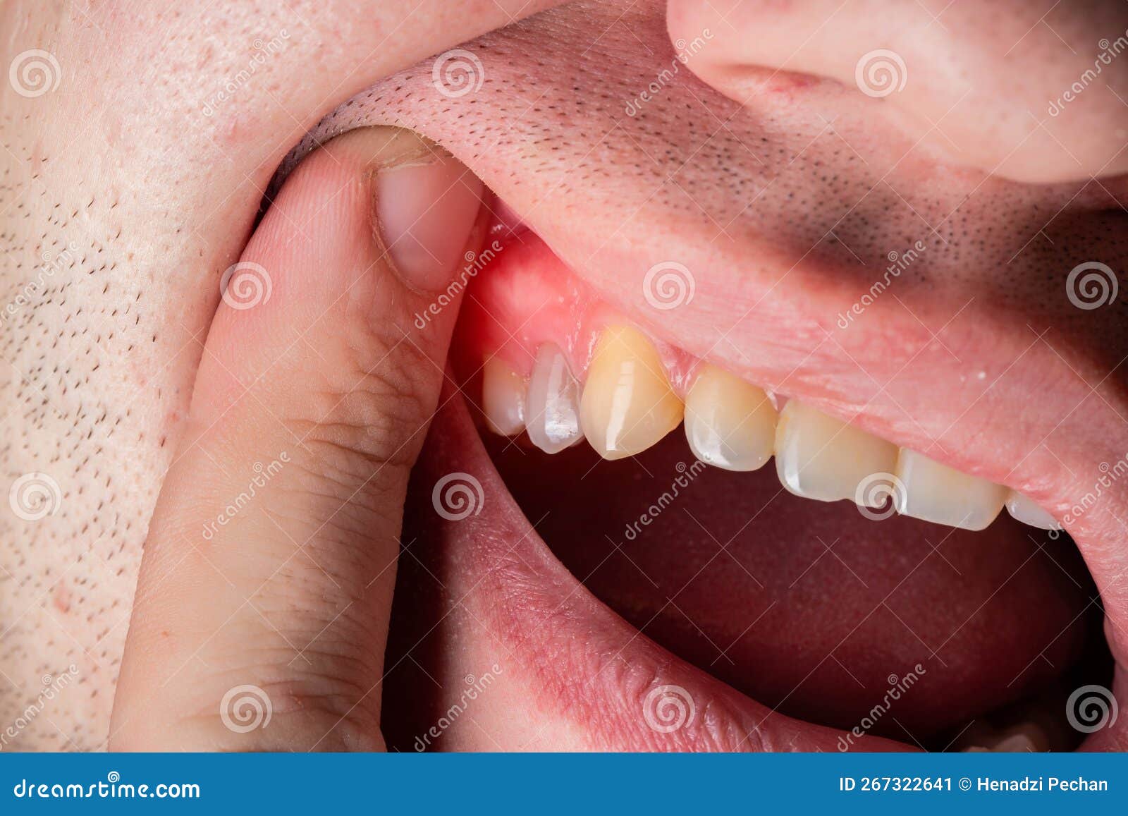 red and swollen gums in a man. gum disease gingivitis, flux and inflammation. macro
