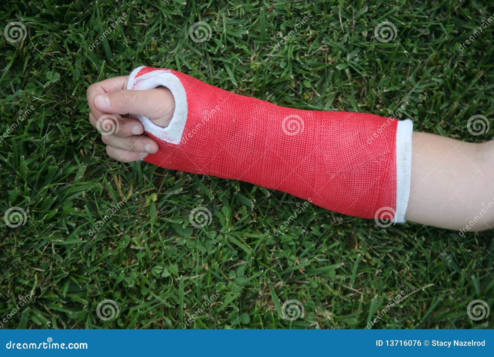 red wrist arm and hand cast