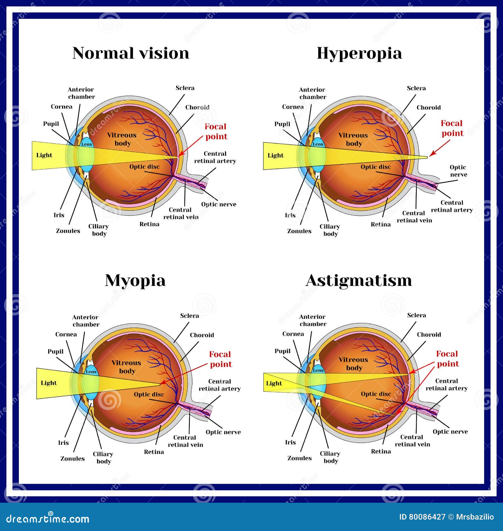vision astigmatism myopia hyperopia xerophthalmia strabismus