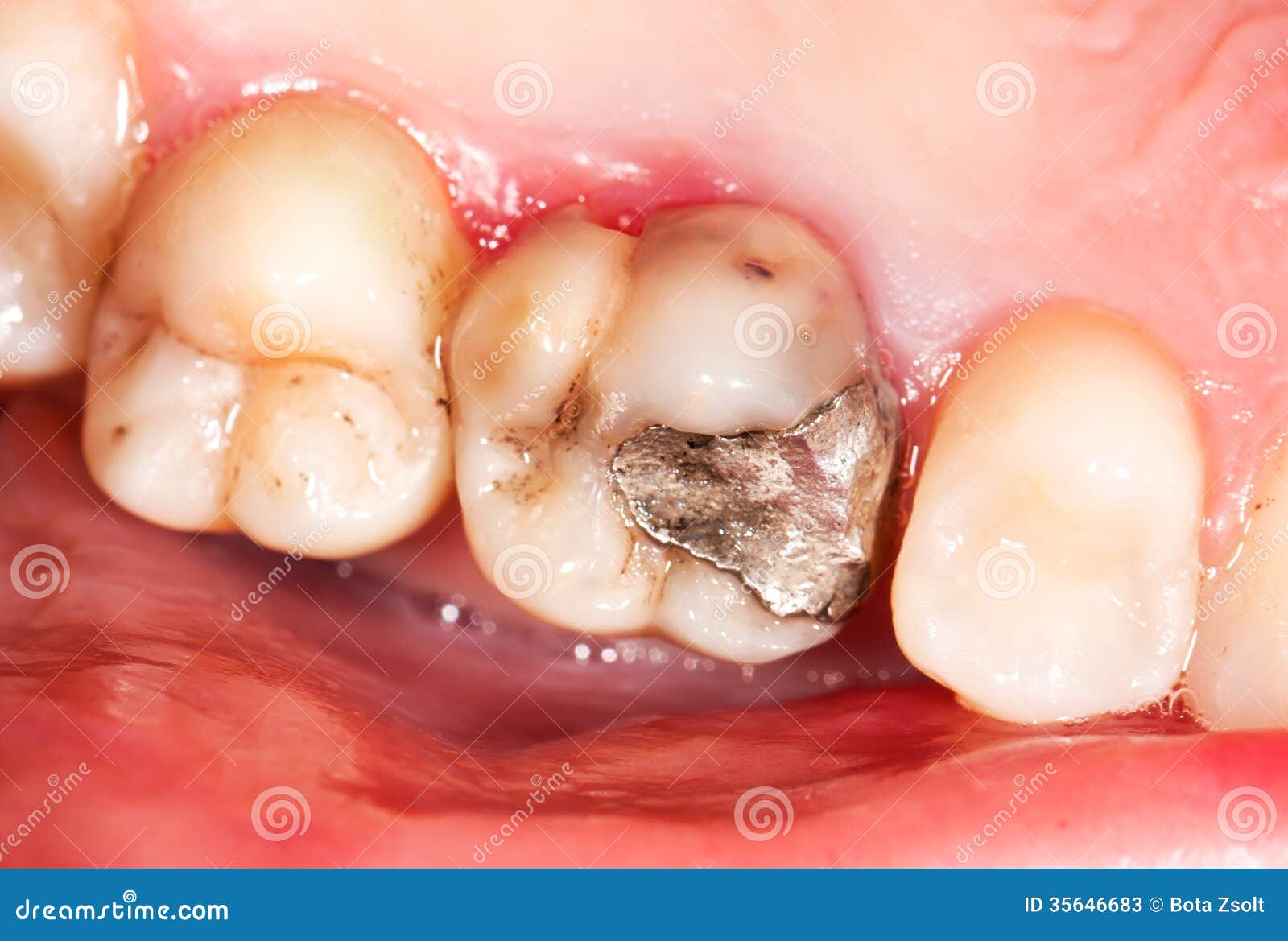 Relleno de amalgama imagen de archivo. Imagen de indiferente 35646683