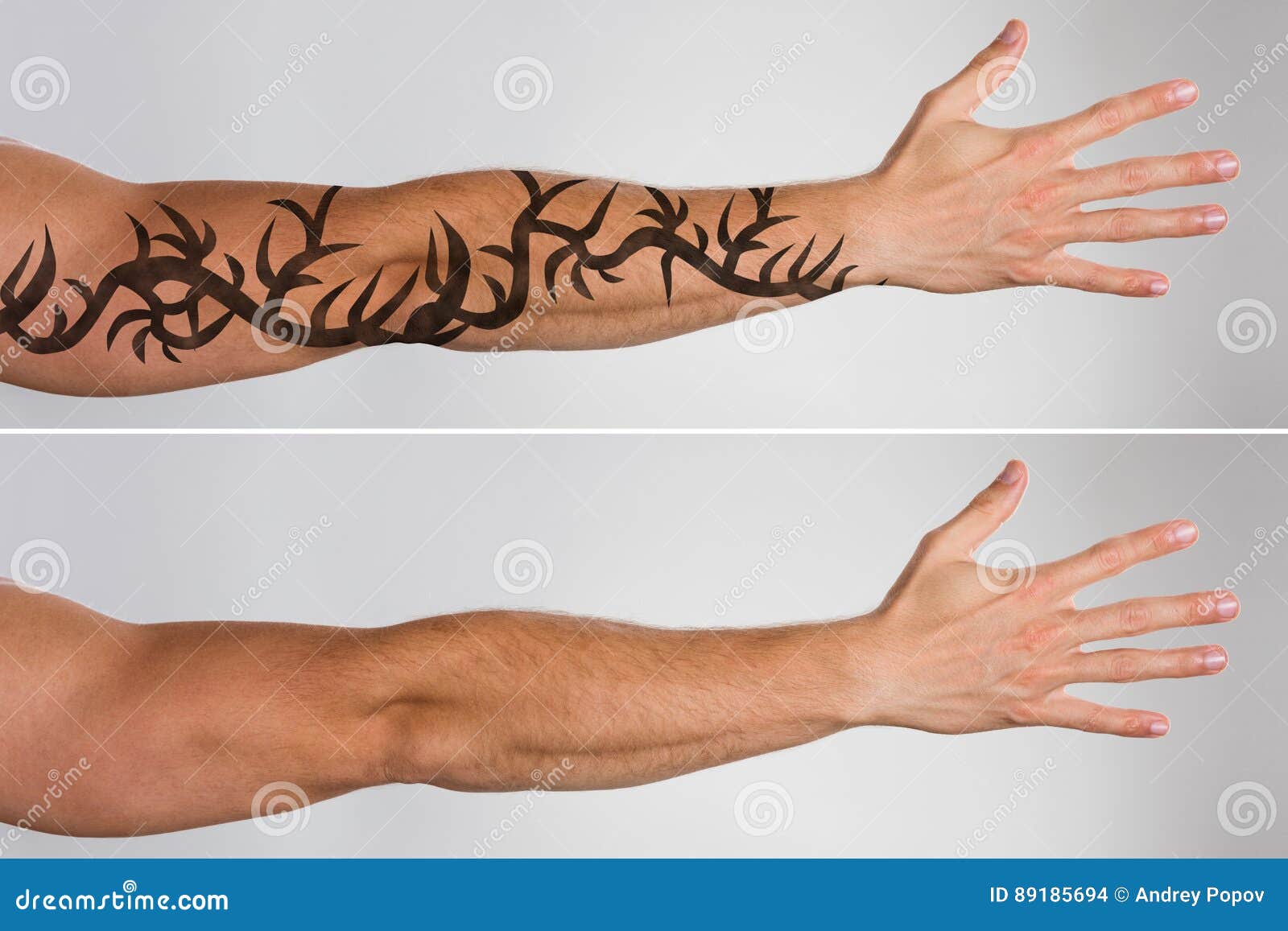 Remoção De Tatuagem Laser Na Mão Das Mulheres Foto de Stock - Imagem de  laser, interior: 214013894