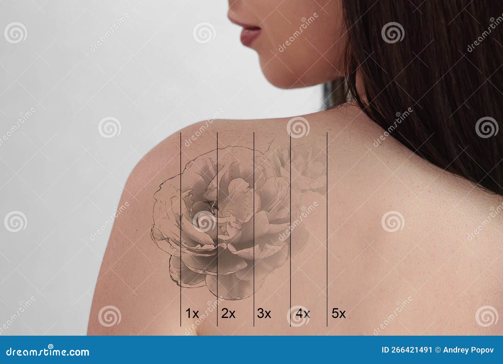 Remoção De Tatuagem Laser Na Mão Das Mulheres Foto de Stock - Imagem de  laser, interior: 214013894