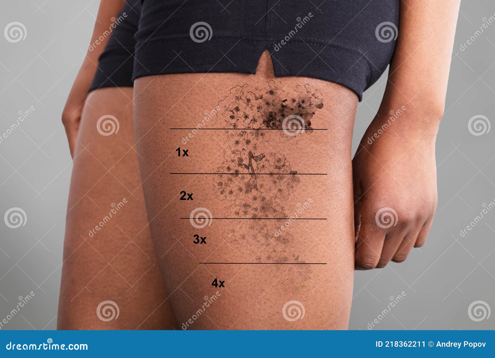 Remoção De Tatuagem Laser Na Mão Das Mulheres Foto de Stock - Imagem de  laser, interior: 214013894