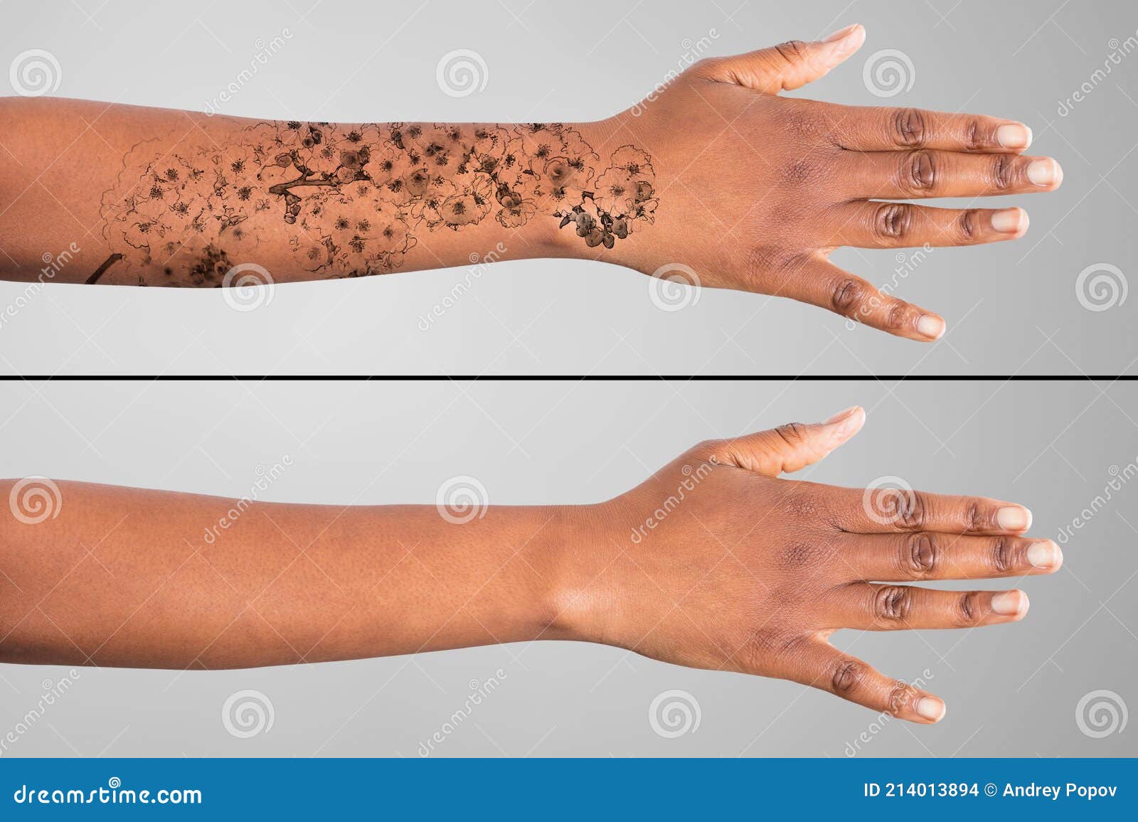 Remoção De Tatuagem Laser Na Mão Das Mulheres Foto de Stock - Imagem de  laser, interior: 214013894